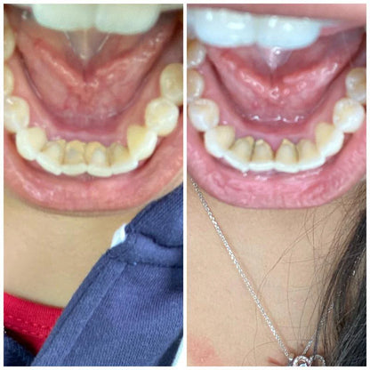 Krivya - Guru Nanda™️ Coconut Oil Pulling W/ Essential Oils (FREE SCRAPER INCLUDED)